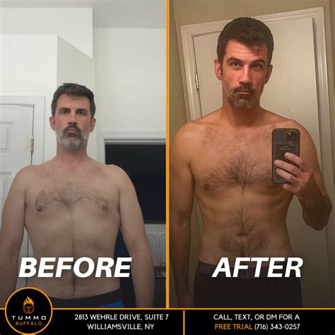 Before & after results and pictures of Electrical Muscle Stimulation .